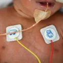 Triplet pregnancies pose substantial risks to both mother and babies, finds KKH audit