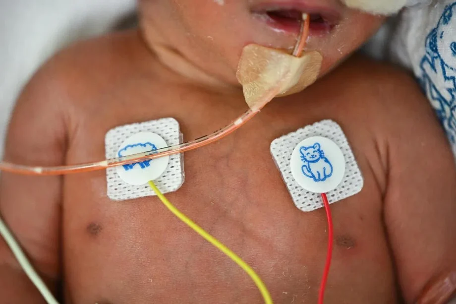 Triplet pregnancies pose substantial risks to both mother and babies, finds KKH audit