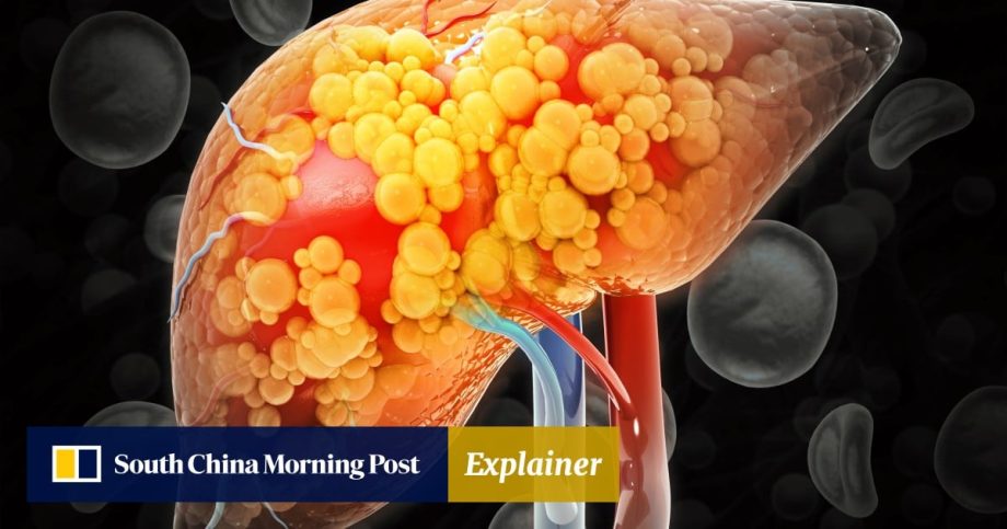 Explainer | What is MASLD? Most common chronic liver disease affects up to 40% of adults