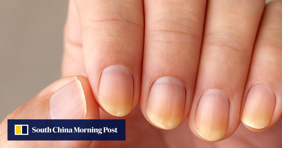 What do nails say about your health? Experts reveal what to look for and how to fix issues