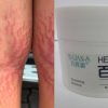Boy, 12, gains 6kg and develops stretch marks after using steroid-tainted cream; HSA flags 3 products, Singapore News