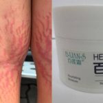 Boy, 12, gains 6kg and develops stretch marks after using steroid-tainted cream; HSA flags 3 products, Singapore News