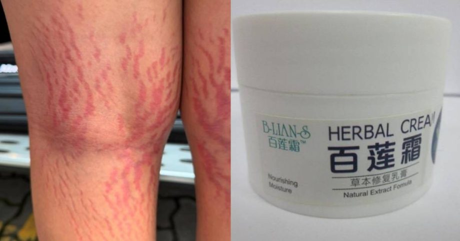 Boy, 12, gains 6kg and develops stretch marks after using steroid-tainted cream; HSA flags 3 products, Singapore News