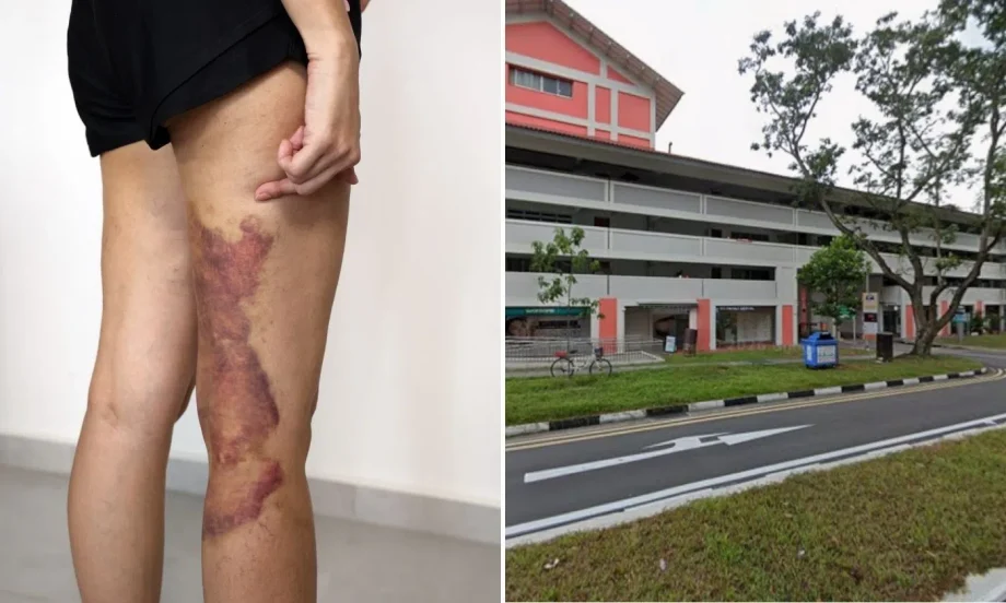 Woman’s legs bruised after gua sha session