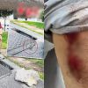 Man suffers cuts to knees and arms after tripping over drain cover on Queen Street: ‘I fell like Superman’, Singapore News