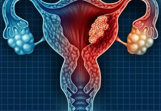 DKSH Launches Colpofix in Singapore to Support Women with HPV-Related Cervical Lesions