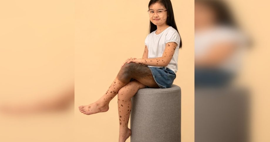Rare birthmark: Charlotte’s giant congenital nevus Rare birthmark: Charlotte’s giant congenital nevus